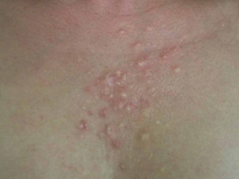 اسکار آکنه فولیکولی