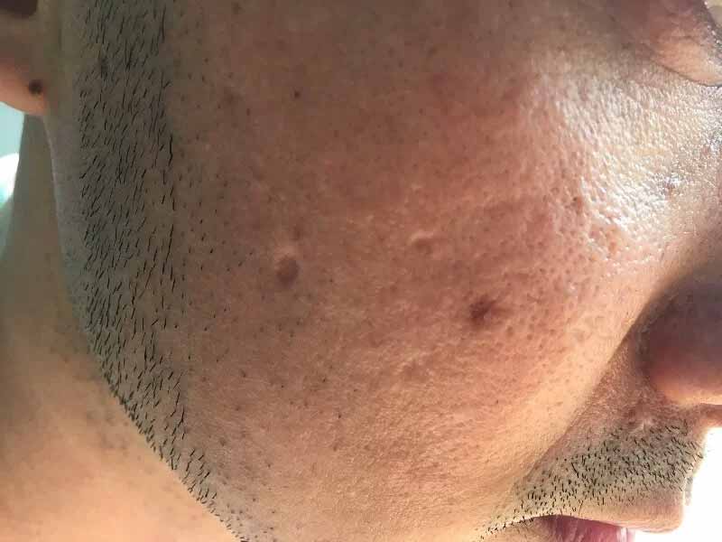 اسکار هایپرتروفیک