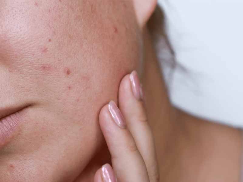 dark spots acne