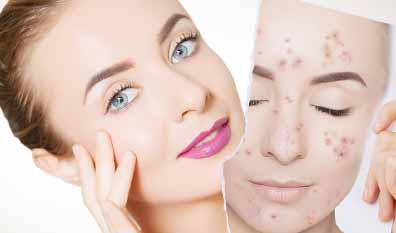 ✅ بهترین روش درمان اسکار آکنه چیست؟ 